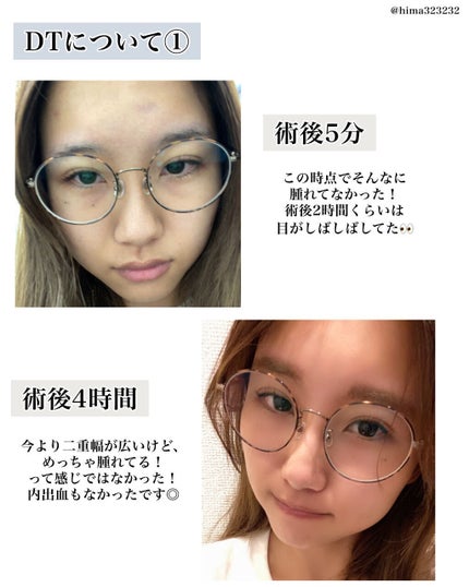 ひまちゃん /垢抜けの参考書 on LIPS 「【整形】〜私が施術した二重埋没について〜本日は!1年半くらい前..」(4枚目)