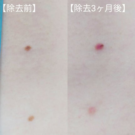 敏感肌な研究者💊あすか💊 on LIPS 「#ホクロをレーザーで除去したお話の経過報告です⚠️患部の写真が..」(6枚目)