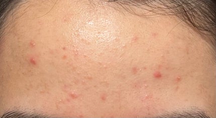 ティーツリーケア ソリューション エッセンシャルマスクEX/MEDIHEAL/シートマスク・パックを使ったクチコミ(1枚目)