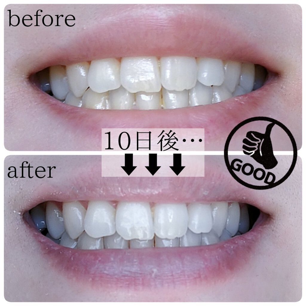 ホワイティエッセンス/MiiS/その他オーラルケアを使ったクチコミ(5枚目)