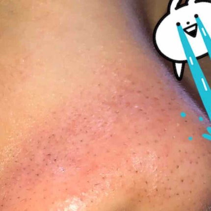 ララ on LIPS 「助けてください😭😭😭鼻の黒ずみが酷いんです、、全体的にニキビ肌..」(4枚目)