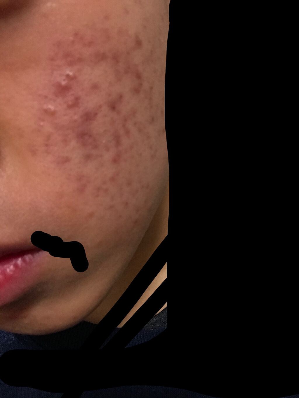 エピデュオゲル/マルホ株式会社/その他を使ったクチコミ（1枚目）