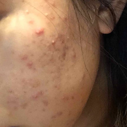 チョコラBBプラス (医薬品)/チョコラBB/その他を使ったクチコミ(2枚目)