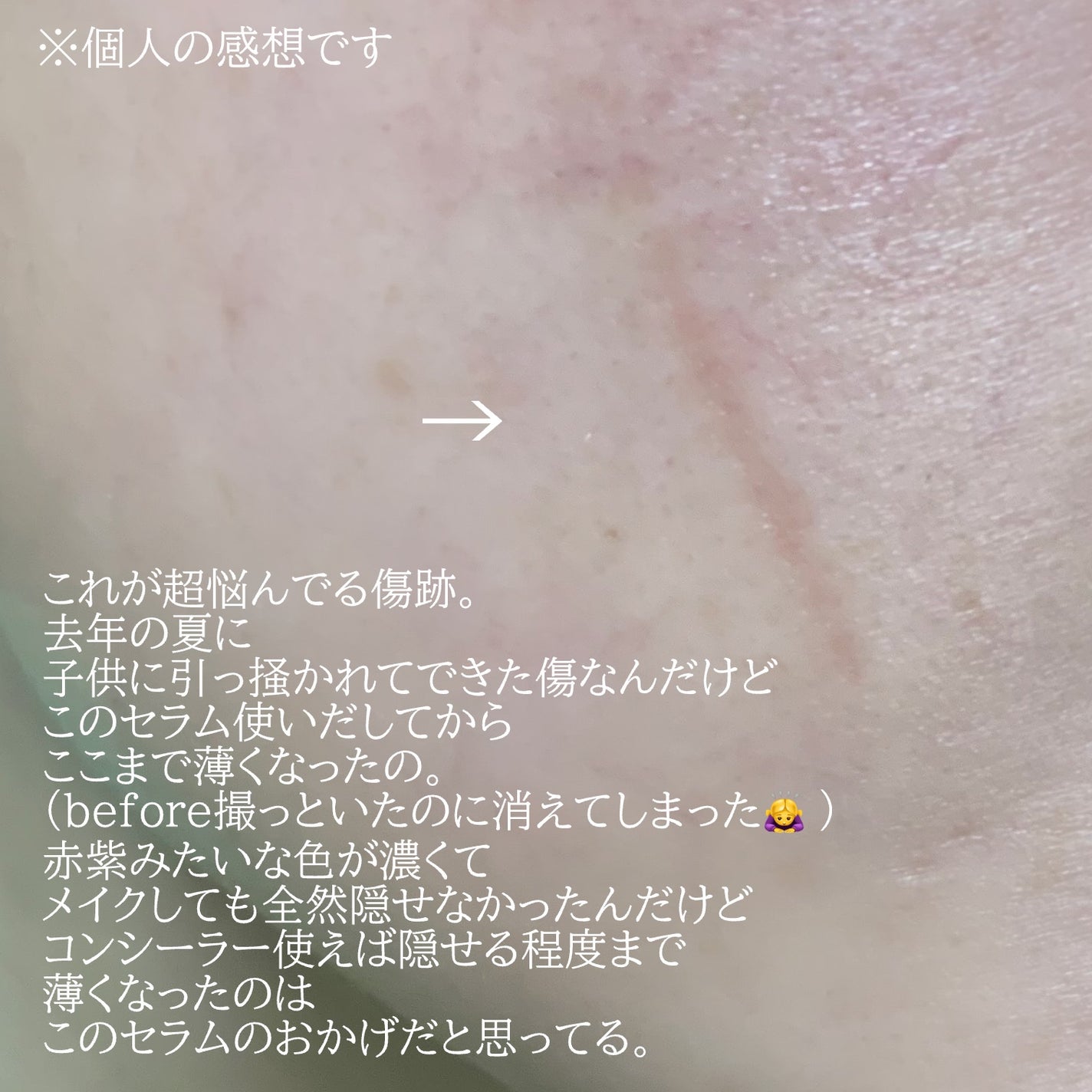 PDRNピンクアンプル PDRN 10,000ppm配合/MEDICUBE/美容液を使ったクチコミ(3枚目)