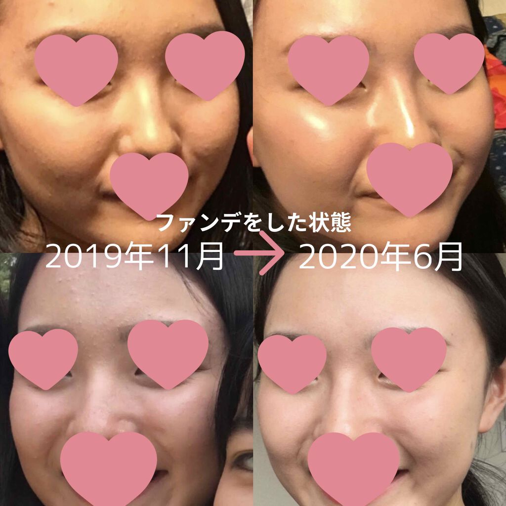 アクネケア エマルジョン R/d プログラム/乳液を使ったクチコミ(3枚目)