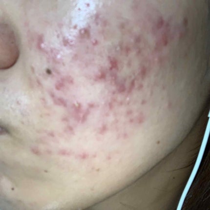 ニキビ治療薬(医薬品)/メンソレータム アクネス/その他を使ったクチコミ(2枚目)