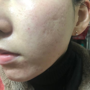 Glucolic Acid 30% Gel Peel/YEOUTH/ピーリングを使ったクチコミ（2枚目）