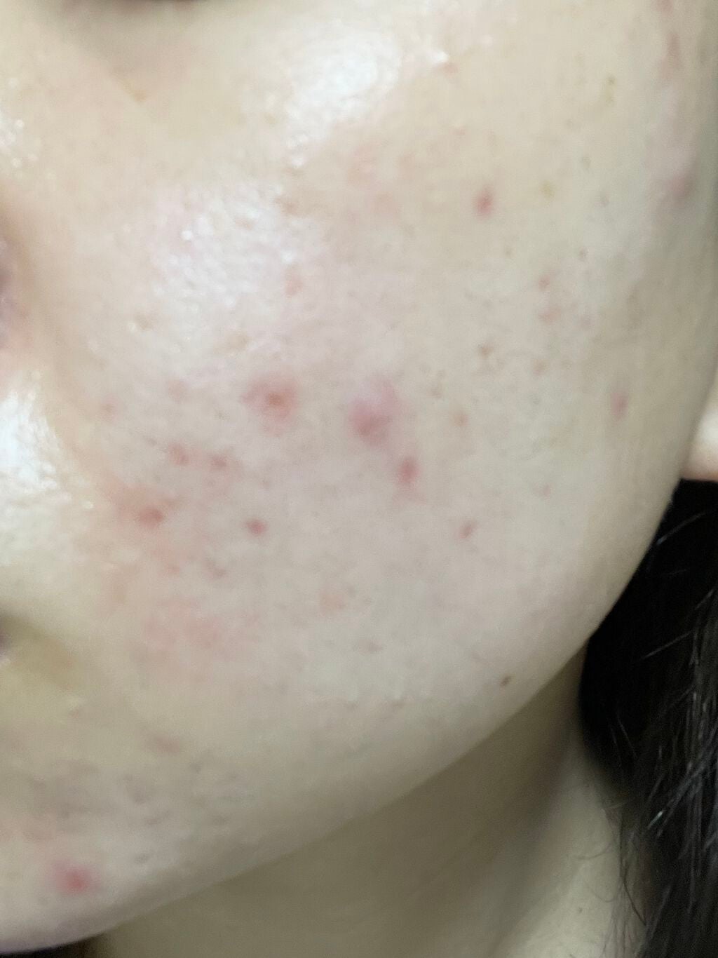 まままこ on LIPS 「ニキビゼロ肌を目指して〜9日目〜⚠️2枚目から肌画像ありスキン..」(3枚目)