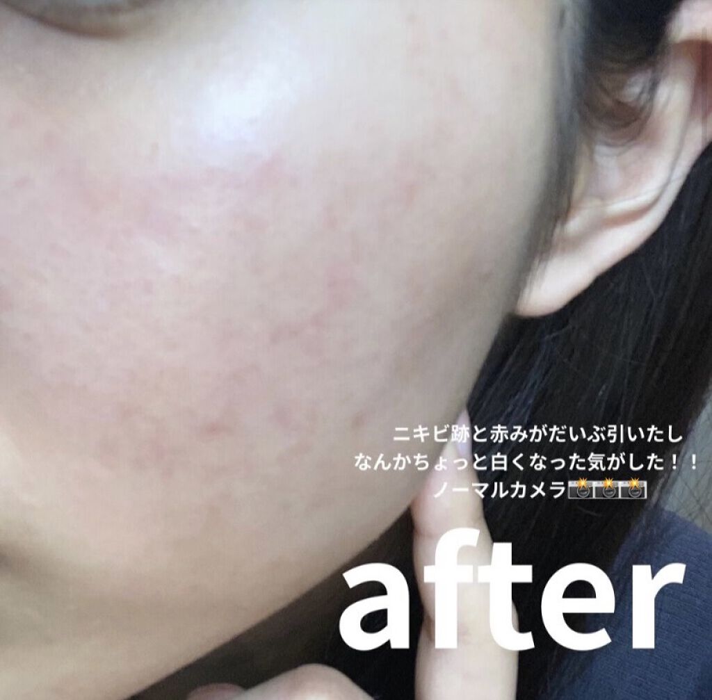 CHOI薬用マスク ニキビケア ［医薬部外品］/肌美精/シートマスク・パックを使ったクチコミ（3枚目）