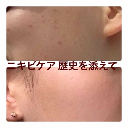 薬用パウダー化粧水/メンソレータム アクネス/化粧水を使ったクチコミ(1枚目)