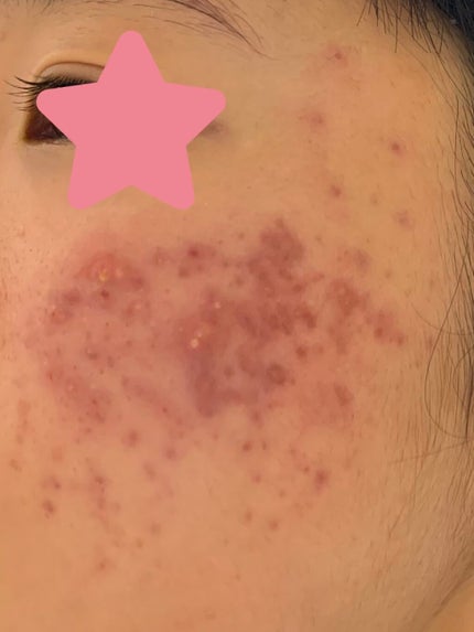 オロナインH軟膏 (医薬品)/オロナイン/その他を使ったクチコミ(3枚目)