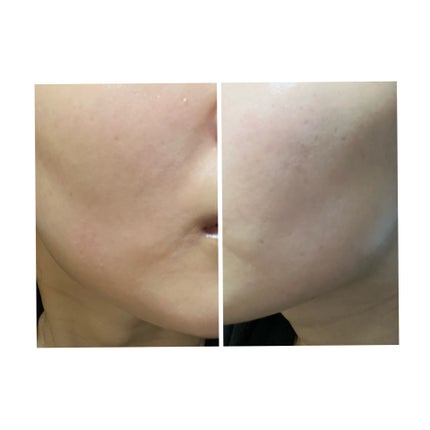 ぽむ on LIPS 「2023.9.13皮膚科に受診 エピデュオとヘパリン処方1枚目..」(5枚目)