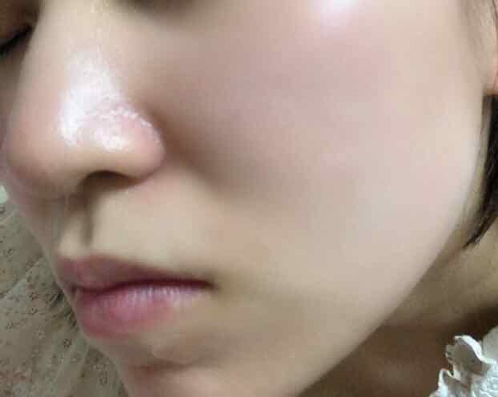 美容部員K on LIPS 「久しぶり大ニキビが出来てしまいました💦小学校高学年〜今までずっ..」(2枚目)