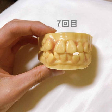 おたむ@フォロバ99 on LIPS 「2019年8月30日からマウスピース矯正を始めてぼちぼち1年が..」(5枚目)