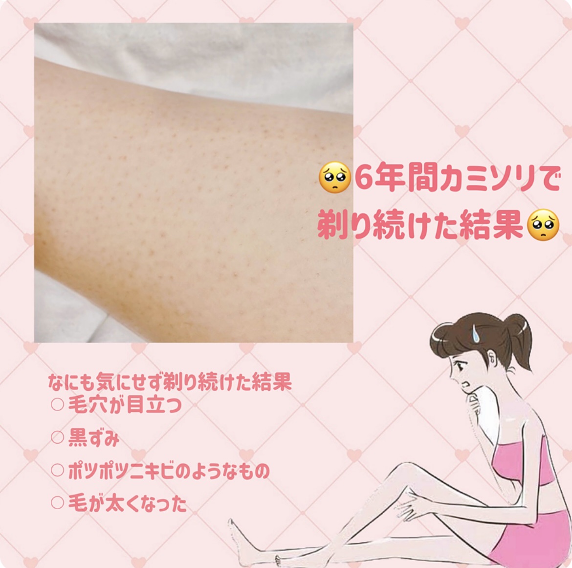 bi-hada ompa L ホルダー替刃2個付/貝印/シェーバーを使ったクチコミ（2枚目）