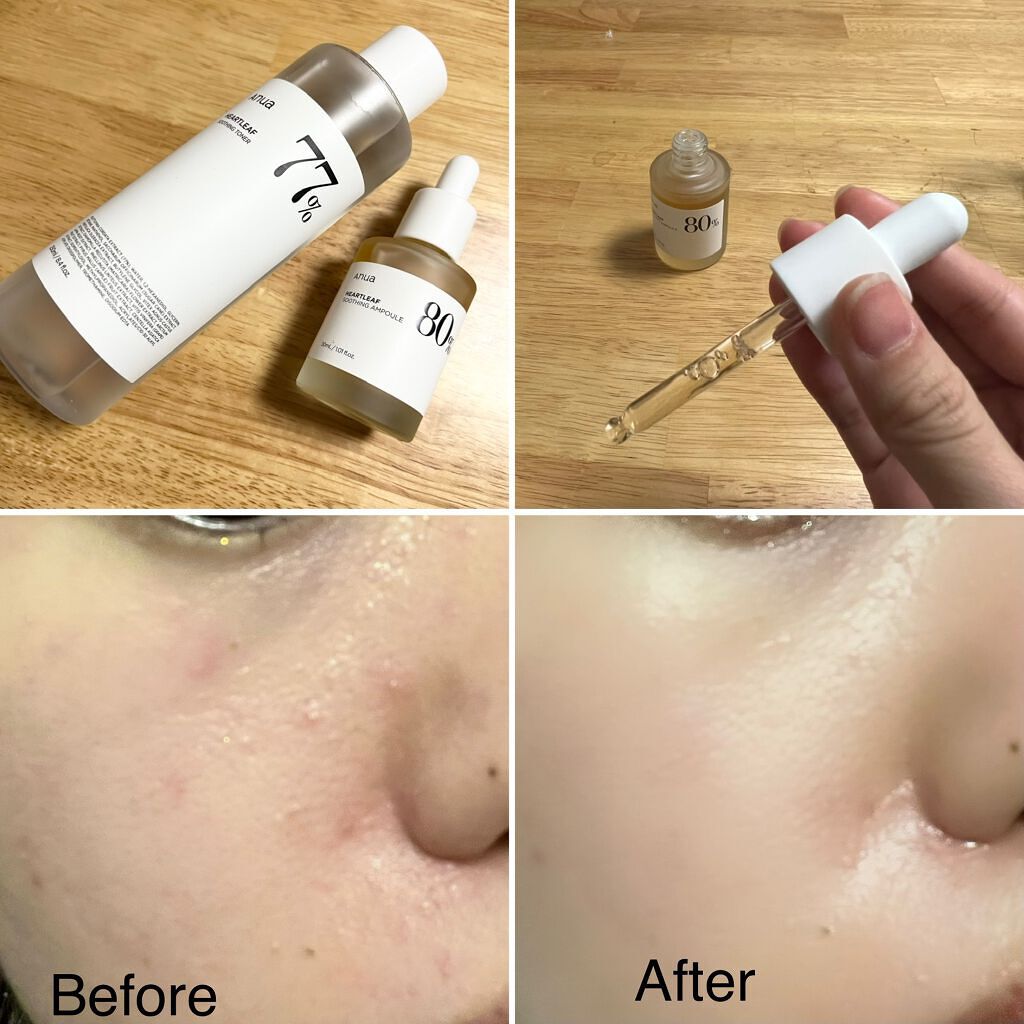 ドクダミ 77 スージングトナー/Anua/化粧水を使ったクチコミ（1枚目）