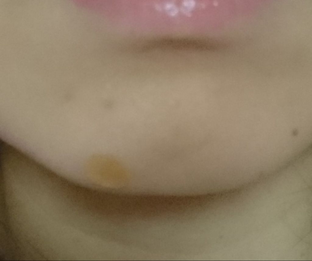 Nexcare/3M nexcare/にきびパッチを使ったクチコミ(2枚目)