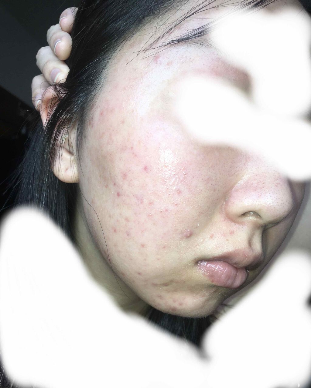 フワフワネコチャン on LIPS 「塗り始めて5日、6日目の朝の写真です。昨日は一日晴れも赤みも引..」(3枚目)