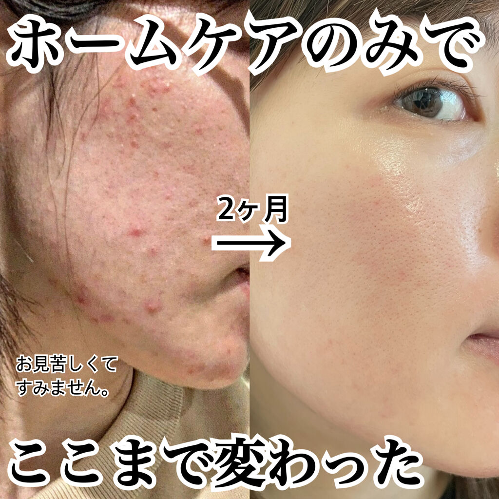 スキンケア方法 Vitamin C Serum Mad Hippie 海外 の使い方 効果 本気でニキビで悩んでい By じろ 混合肌 30代前半 Lips