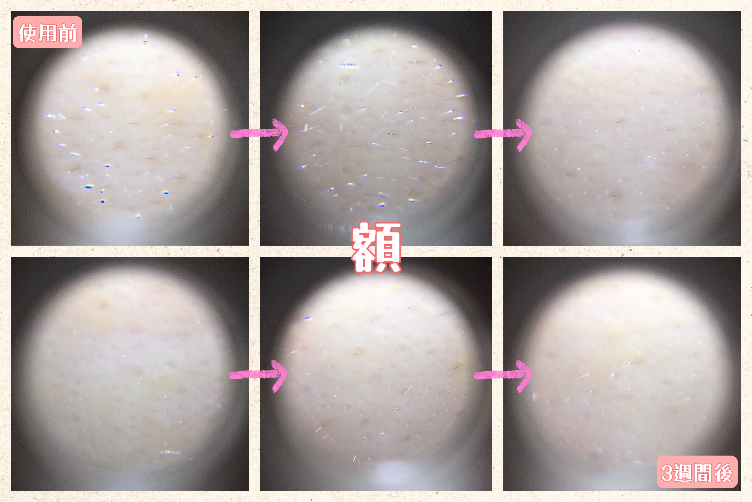 シカレチA クリーム0.05/VT/フェイスクリームを使ったクチコミ（3枚目）