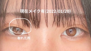 こんぶ on LIPS 「投稿遅くなってしまい申し訳ないです、、私2021年3月に埋没し..」（4枚目）