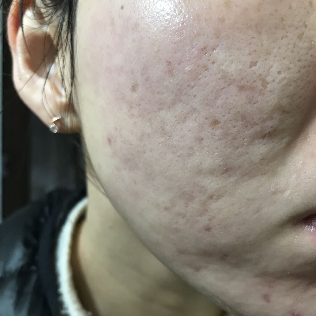 AZアゼライン酸10セラム/コスデバハ/美容液を使ったクチコミ（1枚目）