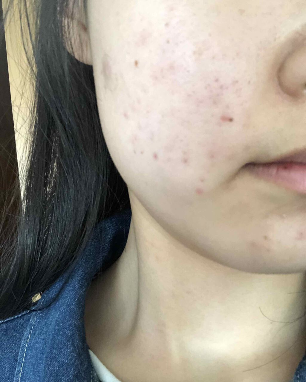 ペアアクネクリームW(医薬品)/ペア/その他を使ったクチコミ（1枚目）