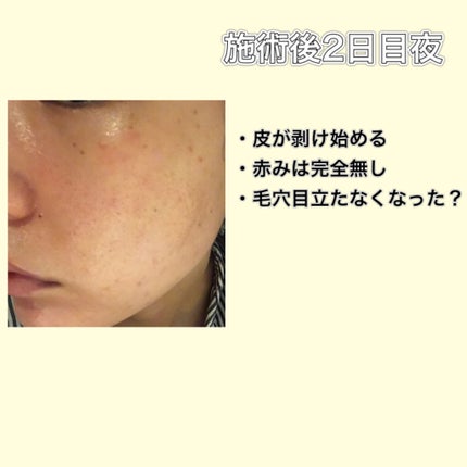 ハイコンセントレイト VC ミスト/&be/ミスト状化粧水を使ったクチコミ(4枚目)