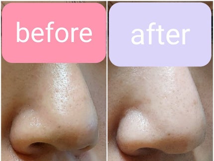 毛穴小町マスク /クリアターン/シートマスク・パックを使ったクチコミ(4枚目)