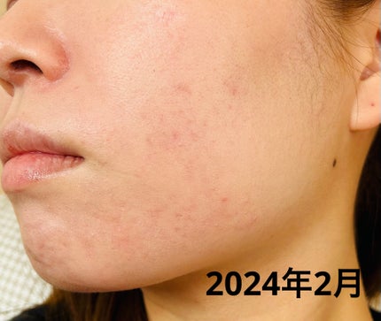 乾燥さん 薬用しっとり化粧液【医薬部外品】/乾燥さん/オールインワン化粧品を使ったクチコミ(2枚目)