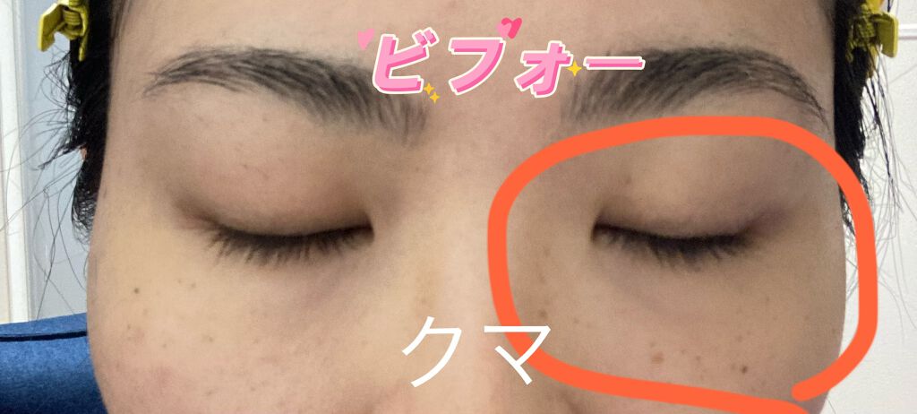 モイストラボ エッセンス薬用美白コンシーラー ナチュラルベージュ01/Moist Labo/リキッドコンシーラーを使ったクチコミ（3枚目）