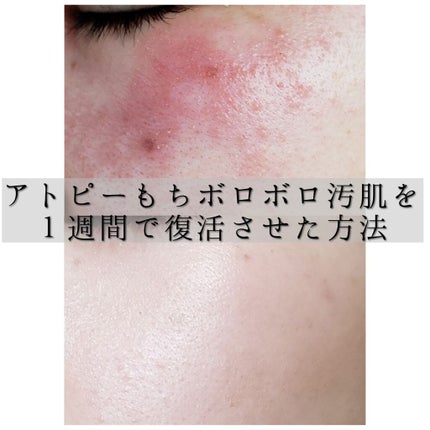 インテンシブ エキナセアクリーム/ARGITAL/フェイスクリームを使ったクチコミ(1枚目)