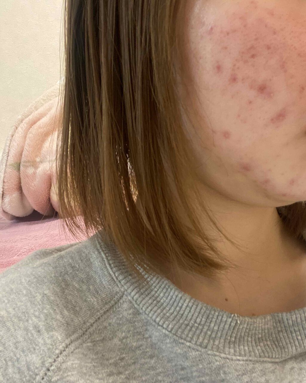 クリンダマイシンゲル(医薬品)/クラシエ薬品/その他を使ったクチコミ（1枚目）