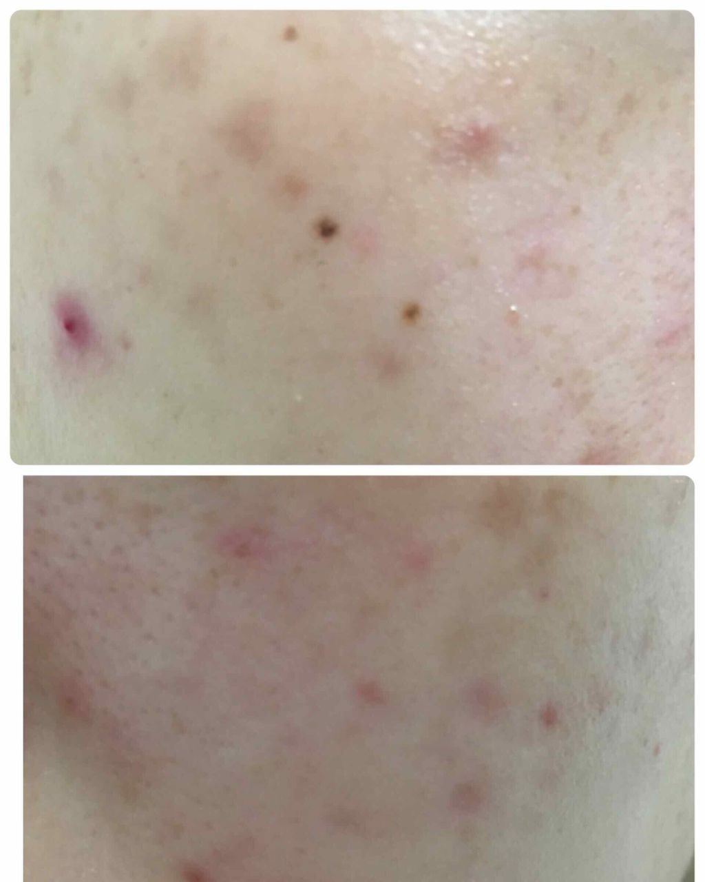 バイオイル/バイオイル/フェイスオイルを使ったクチコミ（2枚目）