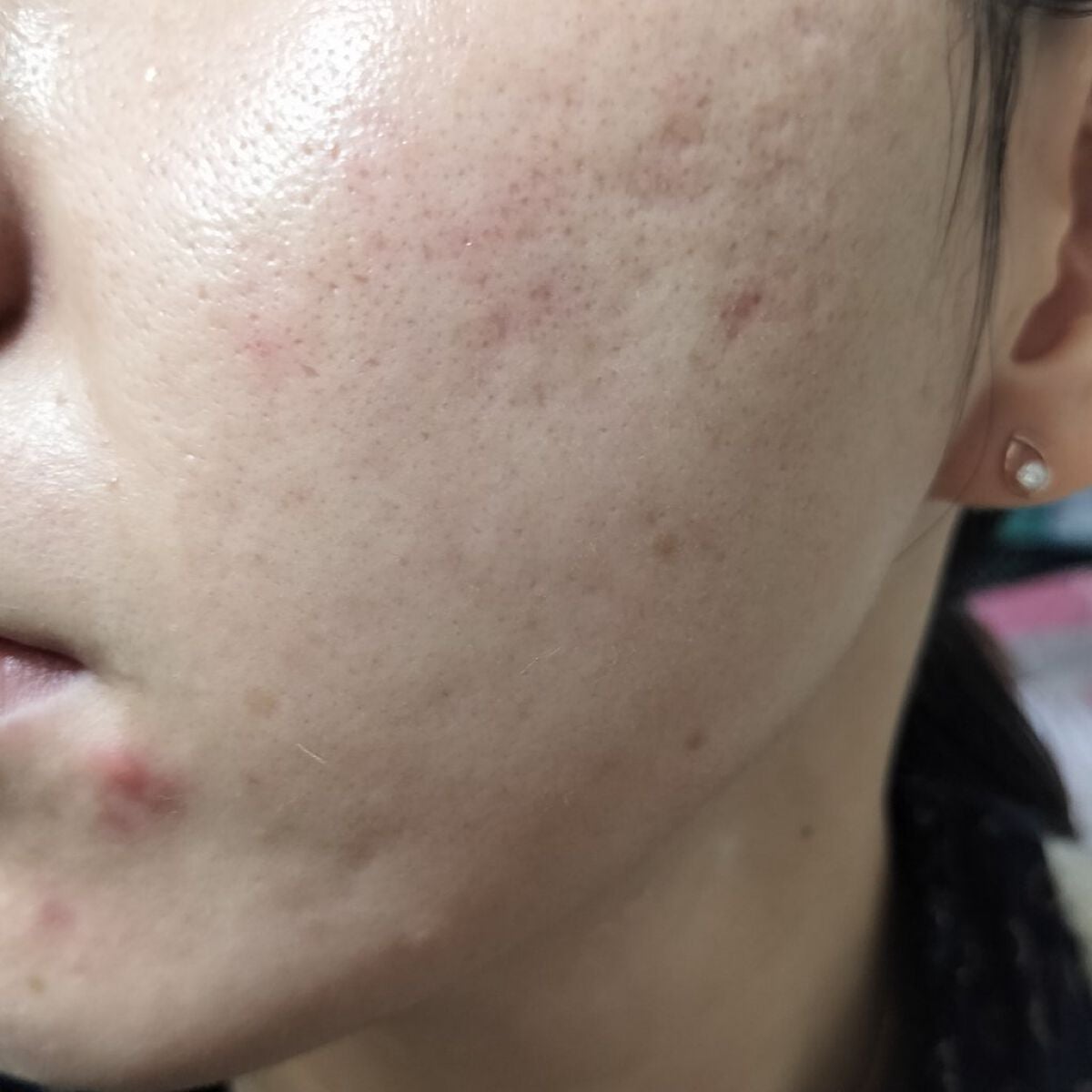 miina@汚肌工事録⚠️ on LIPS 「10/6の#汚肌工事録いつもありがとう。❤/口周りが痛々しい😂..」(2枚目)