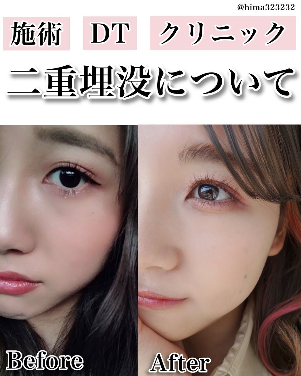 ひまちゃん /垢抜けの参考書 on LIPS 「【整形】〜私が施術した二重埋没について〜本日は!1年半くらい前..」(1枚目)