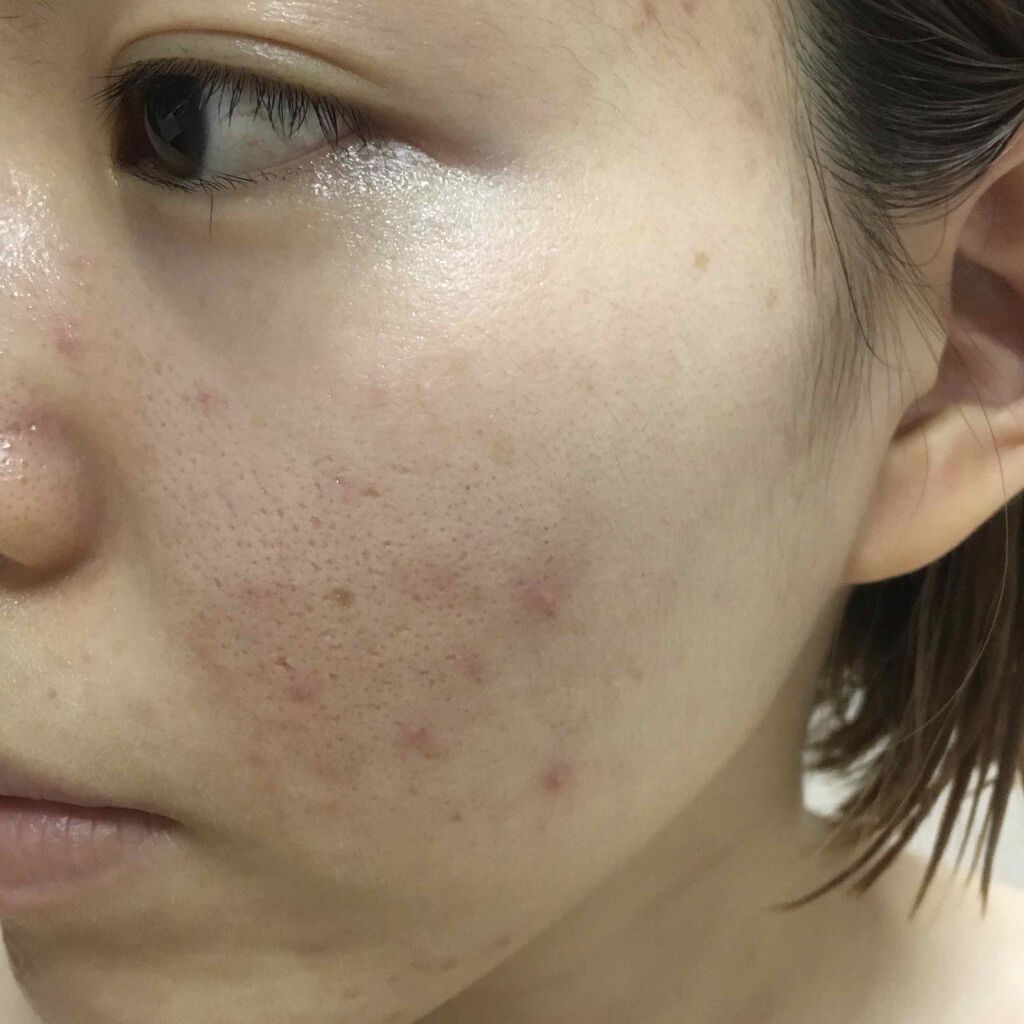 ペアアクネクリームW(医薬品)/ペア/その他を使ったクチコミ（1枚目）