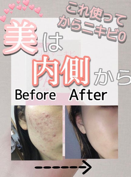 ペアA錠 (医薬品)/ペア/その他を使ったクチコミ(1枚目)