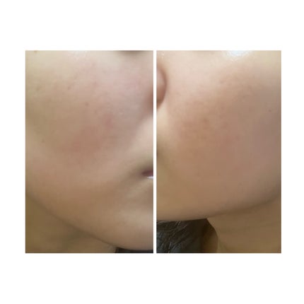 ぽむ on LIPS 「2023.9.13皮膚科に受診 エピデュオとヘパリン処方1枚目..」(5枚目)