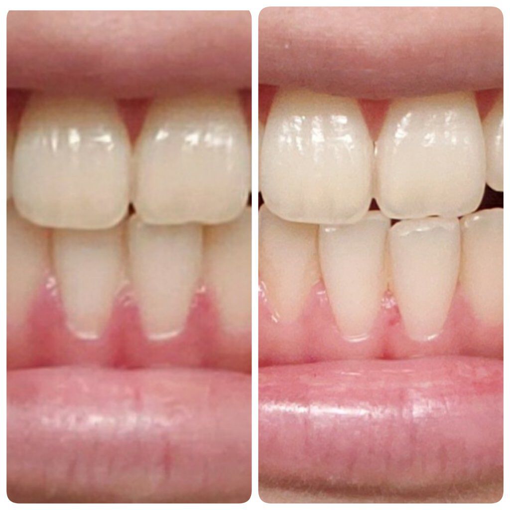 アパガードプレミオ/アパガード/歯磨き粉を使ったクチコミ（2枚目）