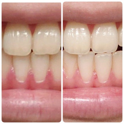 アパガードプレミオ/アパガード/歯磨き粉を使ったクチコミ(2枚目)