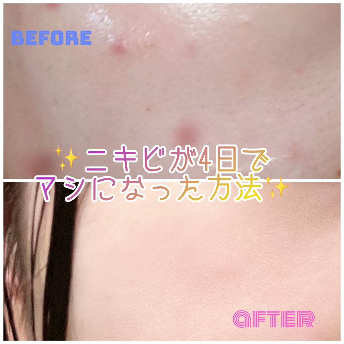 ペアアクネクリームW(医薬品)/ペア/その他を使ったクチコミ（1枚目）