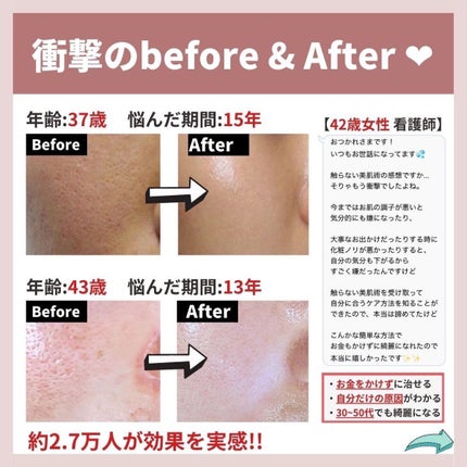 あなたの肌に合ったスキンケア💐コーくん先生 on LIPS 「【4月までに毛穴の開きをなくしたい人だけ見てください。】.
...」(8枚目)