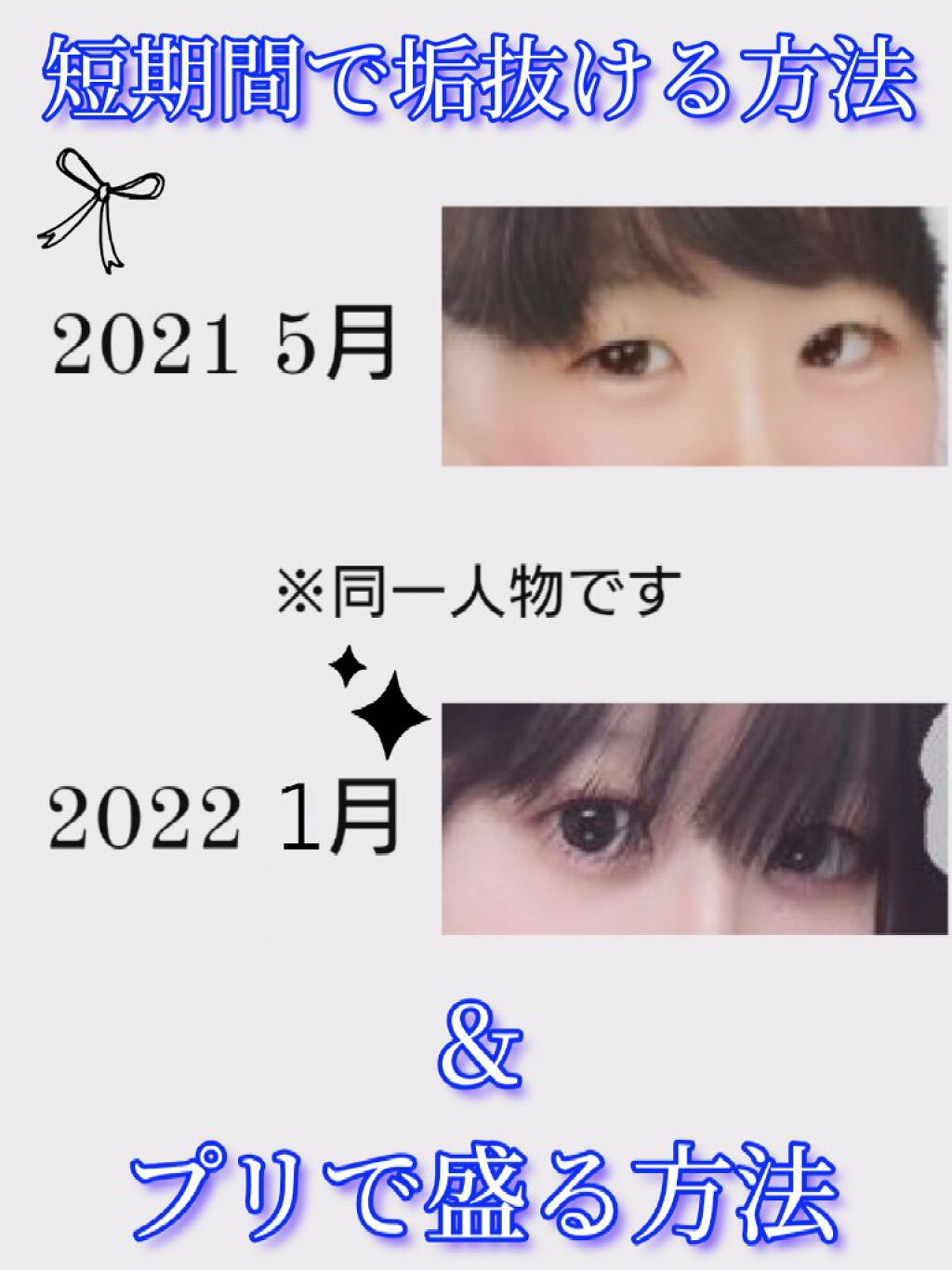 りそうのふたえ 埋没式くっきり形成/DAISO/二重まぶた用アイテムを使ったクチコミ（1枚目）