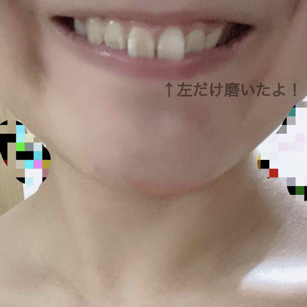 ミュゼホワイトニング 速攻美白 ポリリンキューブ 3個入り/ミュゼホワイトニング/歯磨き粉を使ったクチコミ(2枚目)