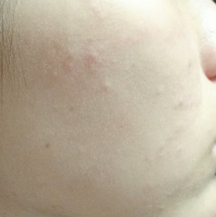 ペアアクネクリームW(医薬品)/ペア/その他を使ったクチコミ(3枚目)