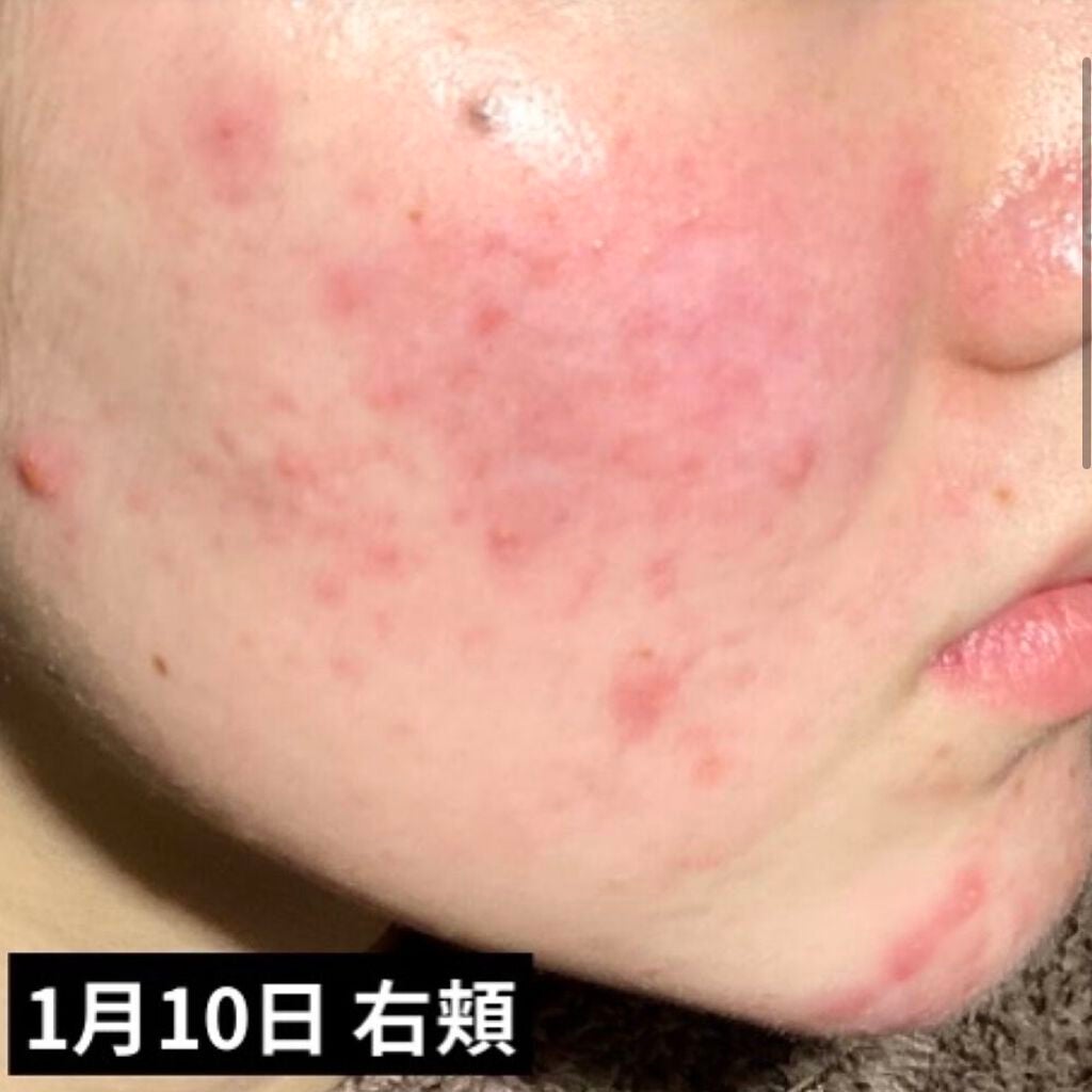 きちぽん on LIPS 「お久しぶりです❕きちぽんです✨皮膚科でもらう薬のディフェリンゲ..」(2枚目)