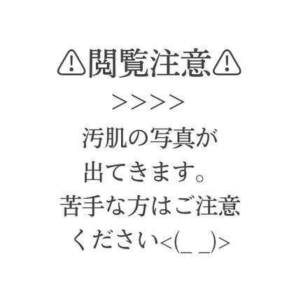 薬用しみ集中対策 プレミアム美容液/メラノCC/美容液を使ったクチコミ(5枚目)