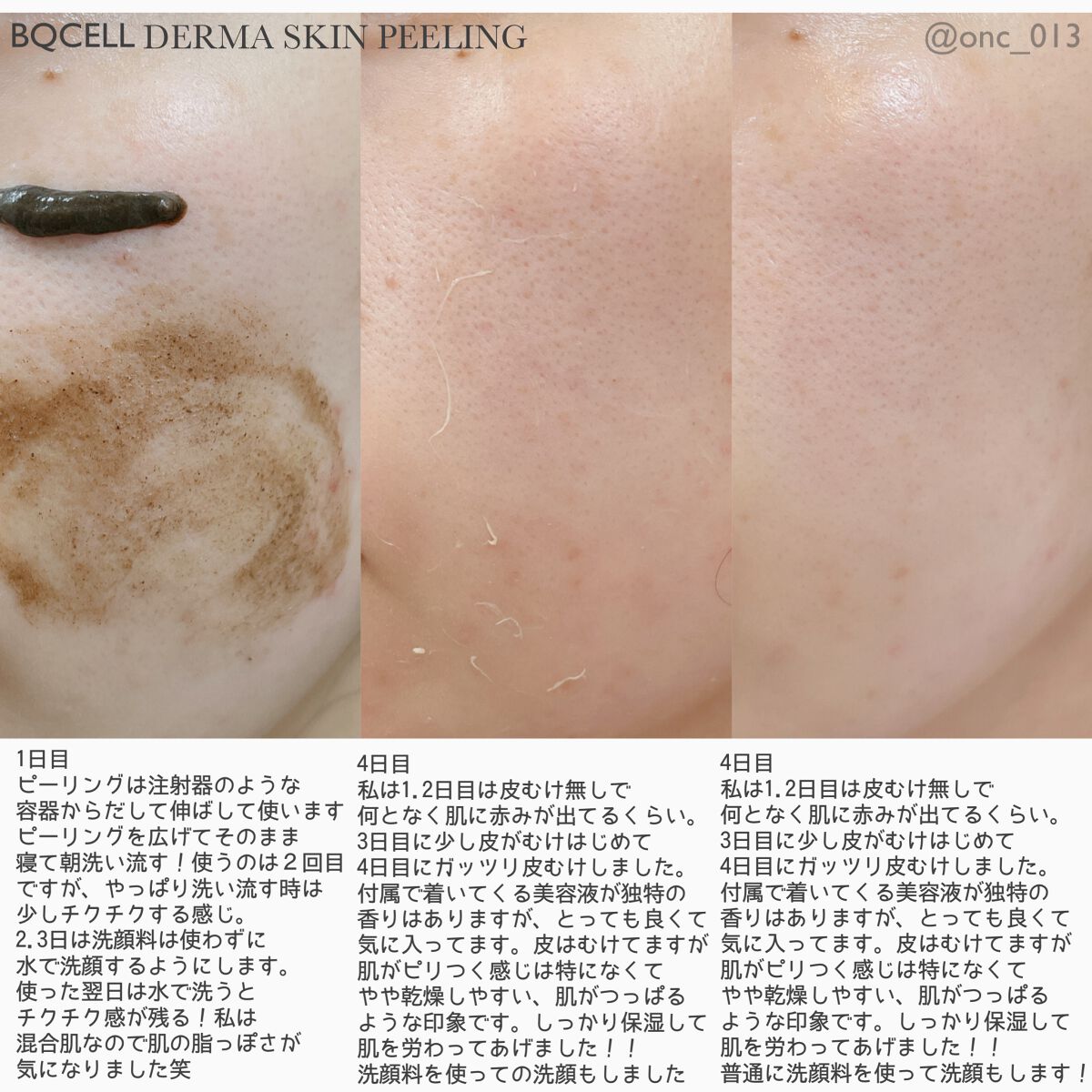 ダーマスキンピーリング/BQCELL/その他キットセットを使ったクチコミ（2枚目）