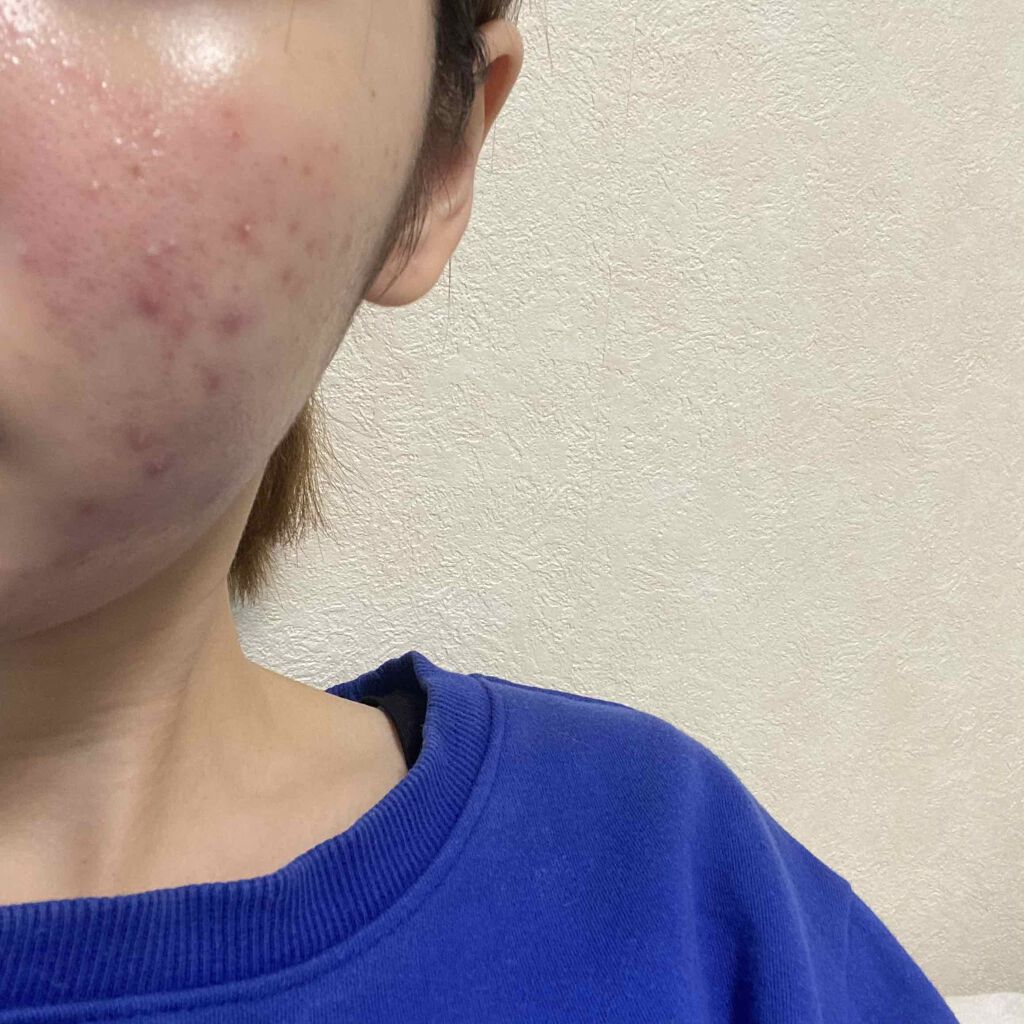 クリンダマイシンゲル(医薬品)/クラシエ薬品/その他を使ったクチコミ（2枚目）